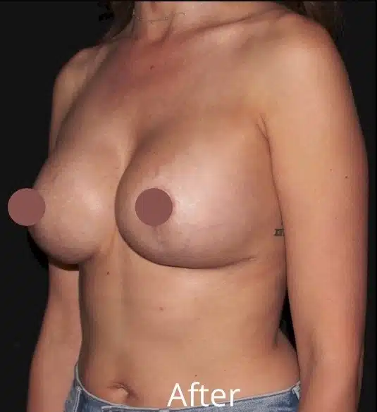 Left oblique view after breast lift with implant exchange highlighting restored upper pole fullness and a lifted breast contour at a cosmetic surgery practice serving Boise and Meridian.