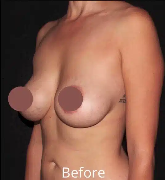 Pre-operative left oblique view before breast lift and implant exchange showing breast ptosis and aging breast implants in Boise, Idaho.