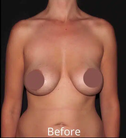 Front view before breast lift with implant exchange showing breast volume loss and implant settling before cosmetic breast revision in the Treasure Valley.
