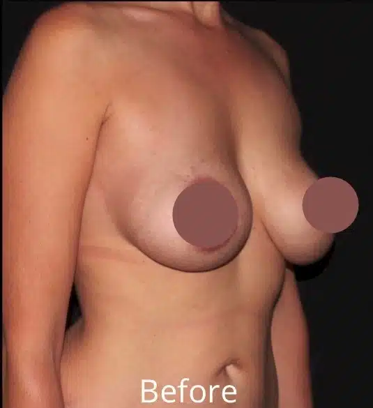 Right oblique view before breast lift with implant exchange showing breast ptosis and reduced implant support before surgery at a Boise, Idaho cosmetic surgery practice.