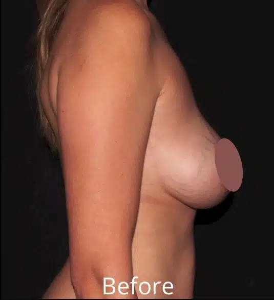 Prior to breast lift with implant exchange, right side profile showing breast sagging and decreased upper pole fullness before revision breast surgery in Boise.