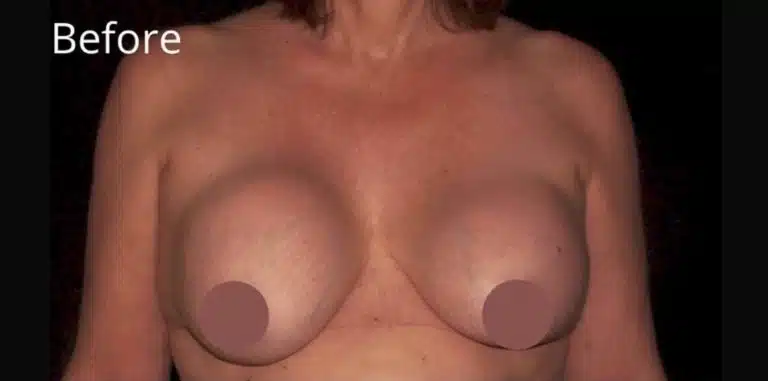 Close-up front view before breast lift, implant exchange, and capsulectomy showing breast implant settling and loss of upper pole fullness before revision surgery at a Boise cosmetic surgery practice.