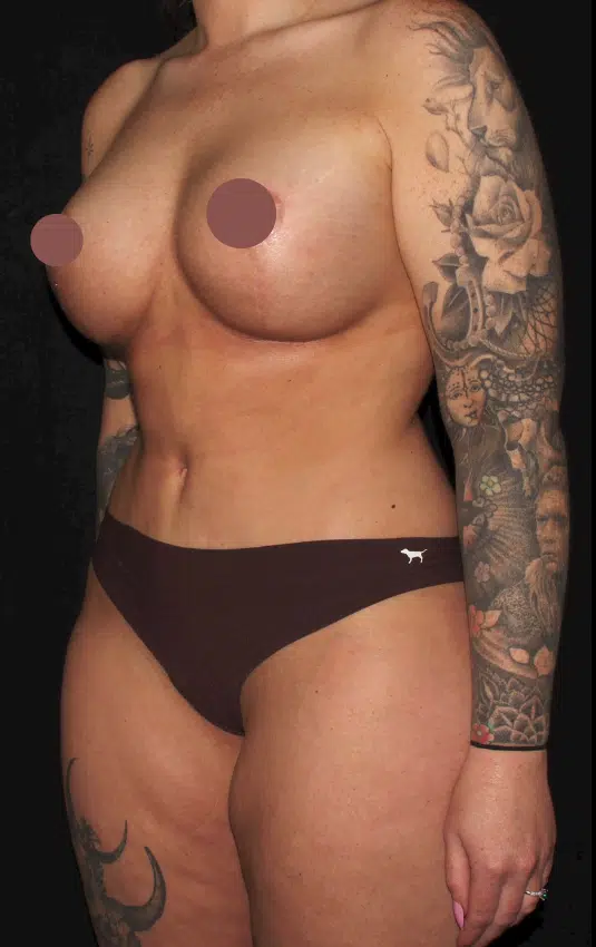 After mommy makeover oblique view of female patient in Treasure Valley showing enhanced breast shape with silicone gel implants and improved waist contour following breast lift and tummy tuck.