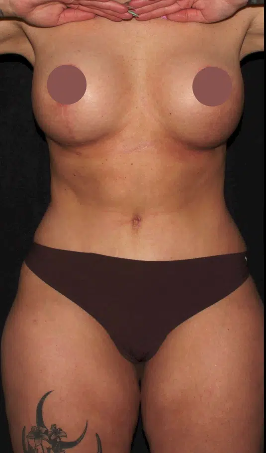 After mommy makeover front view of female patient in Boise, Idaho showing improved breast volume and lift with silicone gel implants and a flatter, tighter abdominal contour following breast augmentation with lift and tummy tuck.