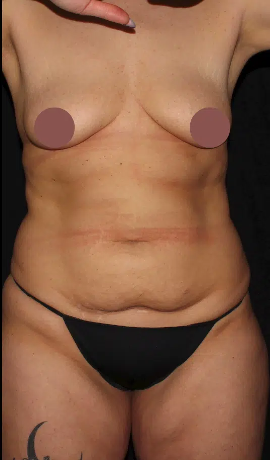 Before mommy makeover front view of female patient showing breast volume loss and abdominal skin laxity following pregnancy prior to breast augmentation with lift and tummy tuck in Boise, Idaho.