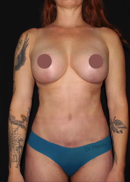 After mommy makeover front view of female patient showing breasts lifted with silicone implants and a tighter, flatter abdomen following lipo 360 and tummy tuck in Meridian, Idaho, with improved body contour and waist definition.
