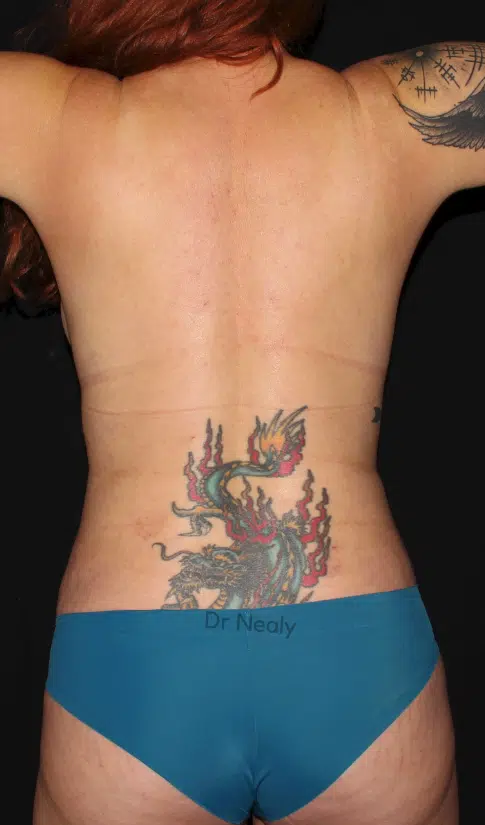 Female body after a mommy makeover in Meridian, Idaho, back view. More defined waist and smoother lower back contours after Lipo 360 and tummy tuck, with tattoo visible.