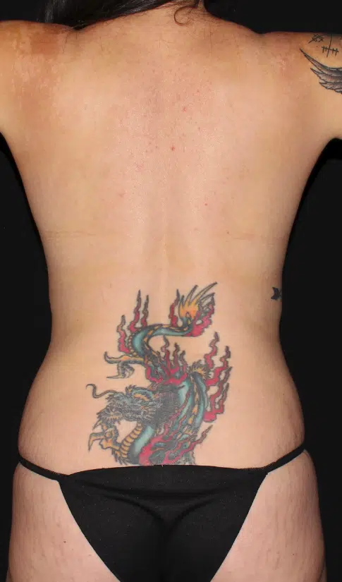 Female body after a mommy makeover, back view. More defined waist and smoother lower back contours after Lipo 360 and tummy tuck, with tattoo visible.