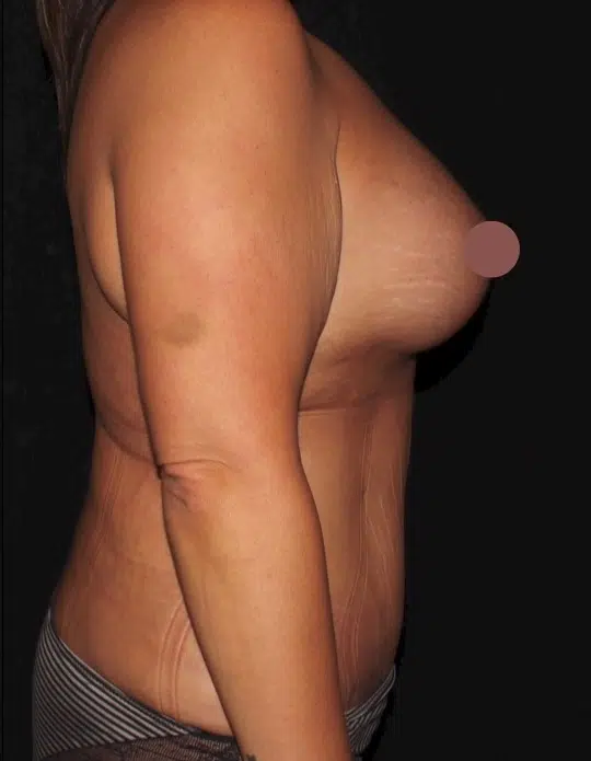 Female body before a mommy makeover, side view. Medium-sized breasts with mild sagging and loose abdominal skin before breast augmentation and tummy tuck.