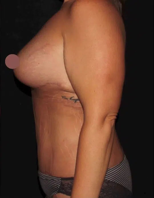 Female body before a mommy makeover, side view. Medium-sized breasts with mild sagging and loose abdominal skin before breast augmentation and tummy tuck.