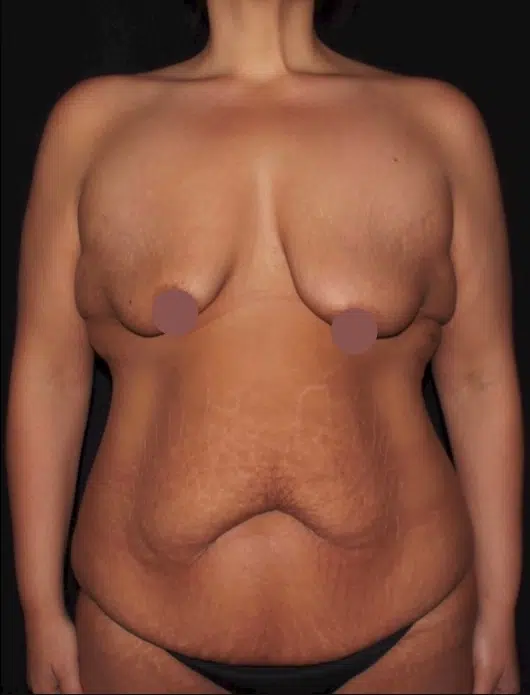 Female body before a mommy makeover, front view. Small breasts with downward projection and loose abdominal skin before breast augmentation and tummy tuck.
