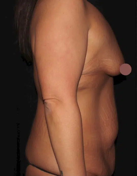 Female body before a mommy makeover, side view. Small breasts with downward projection and loose abdominal skin before breast augmentation and tummy tuck.