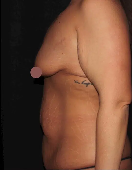 Female body before a mommy makeover, side view. Small breasts with downward projection and loose abdominal skin before breast augmentation and tummy tuck.