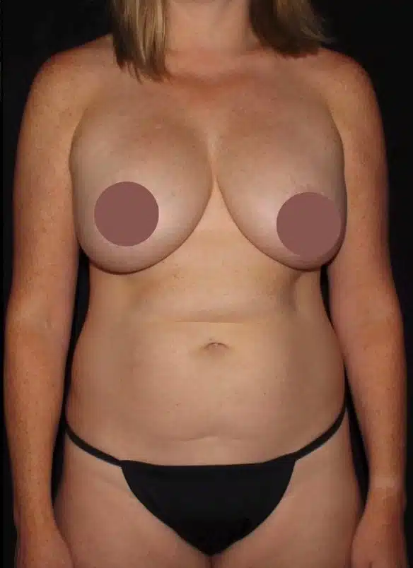 Before front view of female patient in Meridian, Idaho, showing breast deflation prior to implant exchange with breast lift and Lipo 360, including abdominal, flank, and lower back fullness before mommy makeover surgery.