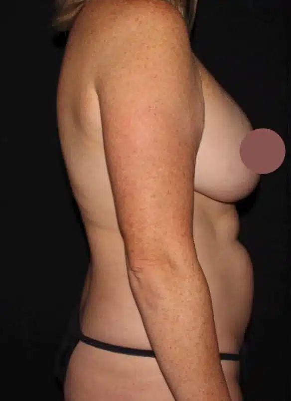 Before side profile showing flank and lower back fullness prior to body contouring surgery.