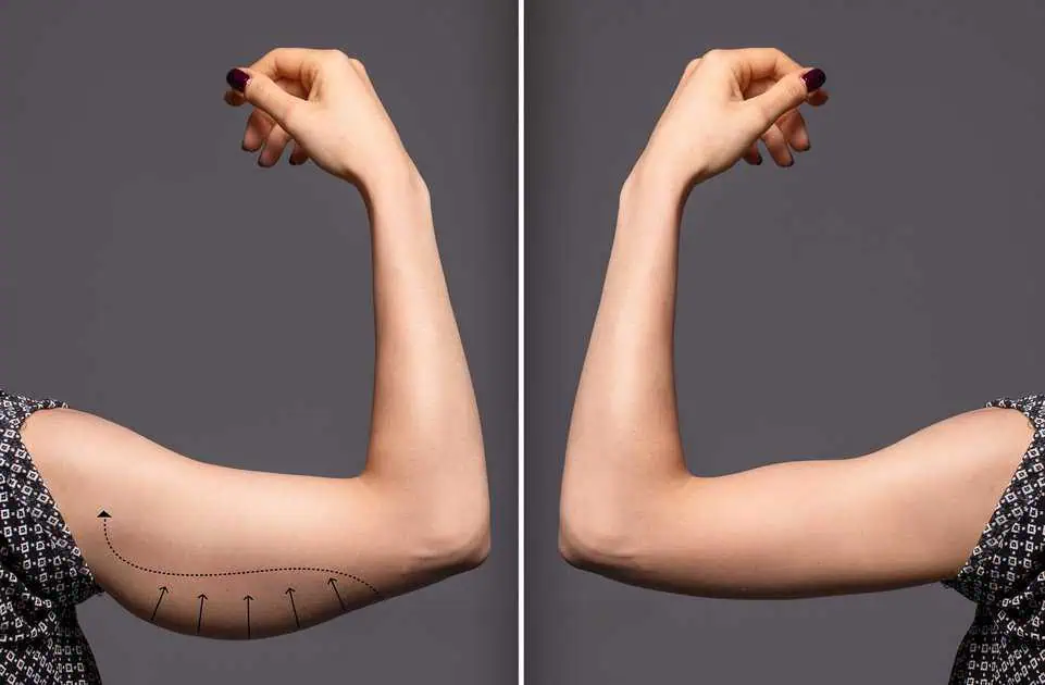 Arm-lift in Boise, ID by Silk Touch Cosmetic Surgery, Lipo, & Medspa