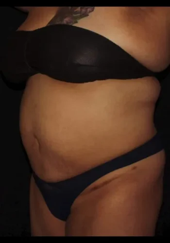 Silk_Touch-mai-Abdomen-Waist-Case-d-after-a-In-Boise-ID