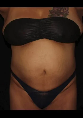 Silk_Touch-mai-Abdomen-Waist-Case-d-after-b-In-Boise-ID