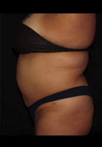 Silk_Touch-mai-Abdomen-Waist-Case-d-after-c-In-Boise-ID