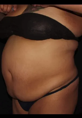Silk_Touch-mai-Abdomen-Waist-Case-d-before-a-In-Boise-ID
