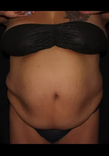 Silk_Touch-mai-Abdomen-Waist-Case-d-before-b-In-Boise-ID