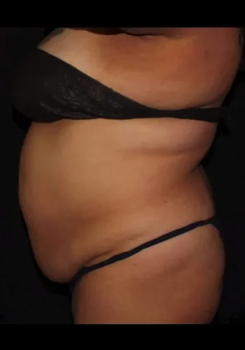 Silk_Touch-mai-Abdomen-Waist-Case-d-before-c-In-Boise-ID